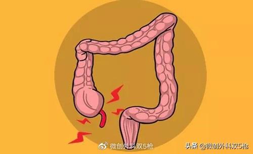 阑尾炎典型的腹痛部位（腹痛之常见原因）(2)