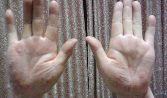 手部皮肤老是脱皮是怎么回事（手部脱皮可能是这四种皮肤病导致的）(4)