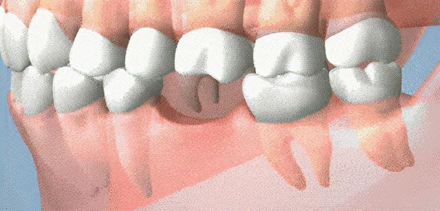 拔牙后多长时间可以做种植牙修复（No.25拔牙两年了）(2)
