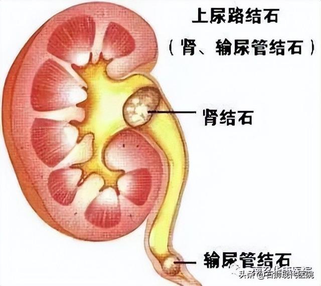 输尿管结石有什么症状怎么能治好（输尿管结石有哪些症状表现）(1)