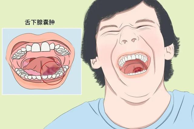 舌下腺囊肿早期怎么治疗（您知道什么是舌下腺囊肿吗）(1)