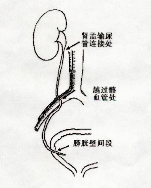 一般什么引起输尿管结石（不要忽视输尿管里的小结石）(2)