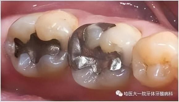 补牙和修复牙齿有什么区别（补牙知多少）(13)