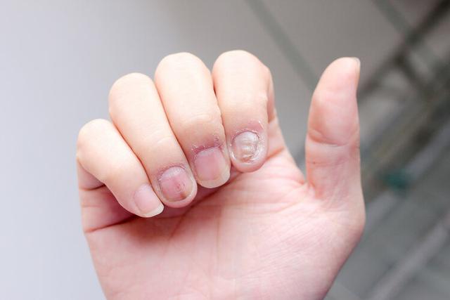 指甲出现4种症状 或是癌症征兆（指甲若长成6种样子）(3)