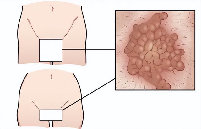 hpv感染的女性一定会得宫颈癌吗（hpv为什么会导致宫颈癌）(2)