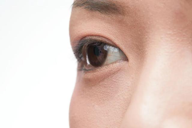戴美瞳引起角膜炎怎么办？干涩感染角膜穿孔(2)