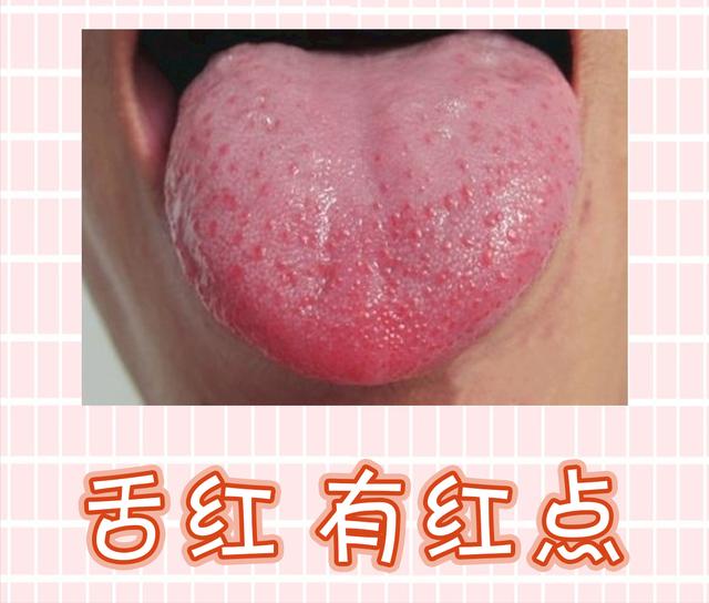 宝宝的舌苔怎样才算正常（宝宝常见的4类舌苔）(2)