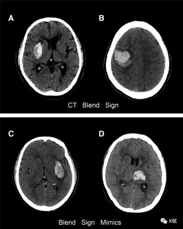 典型疾病影像诊断脑出血的ct表现（CT图像中脑出血血肿扩大的十个征象）(6)