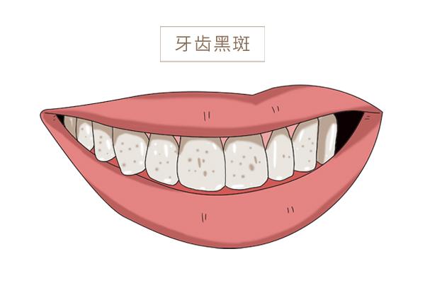 牙齿有黑点和一个洞是蛀牙吗（牙齿上有黑点是蛀牙吗）