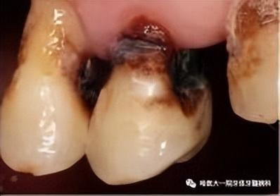 补牙和修复牙齿有什么区别（补牙知多少）(11)