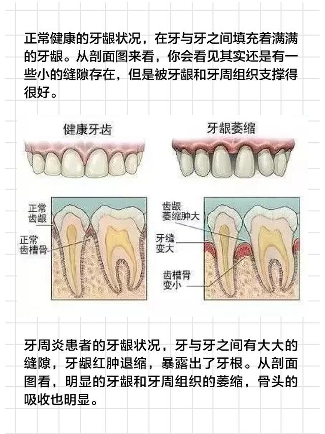 牙齿为什么会牙缝大（为何会出现牙缝增大）(4)