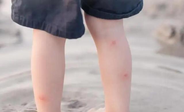 小孩被蚊子咬过敏怎么办（娃娃被蚊子咬得皮肤过敏）(2)