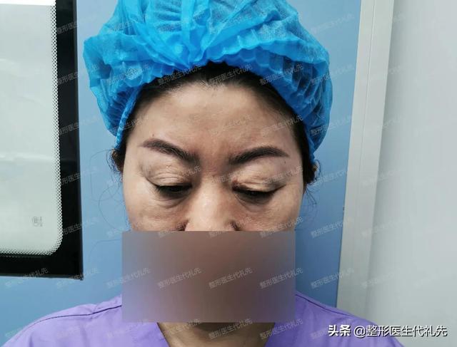 双眼皮加祛眼袋手术多久恢复（60岁来北京做全切双眼皮）