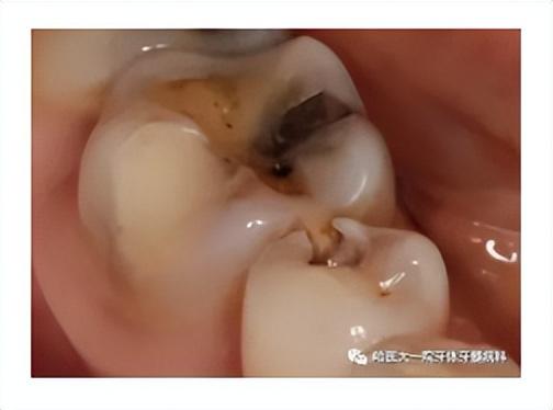 补牙和修复牙齿有什么区别（补牙知多少）(2)