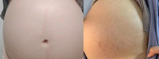 怀孕后哪些孕妇不容易长妊娠纹（怀孕期间身上出现这3种征兆）