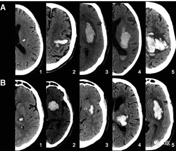典型疾病影像诊断脑出血的ct表现（CT图像中脑出血血肿扩大的十个征象）(4)