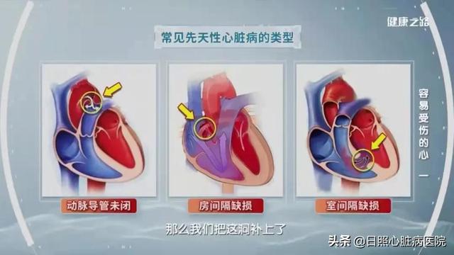 先天性心脏病会严重吗（先天性心脏病您了解吗）(1)