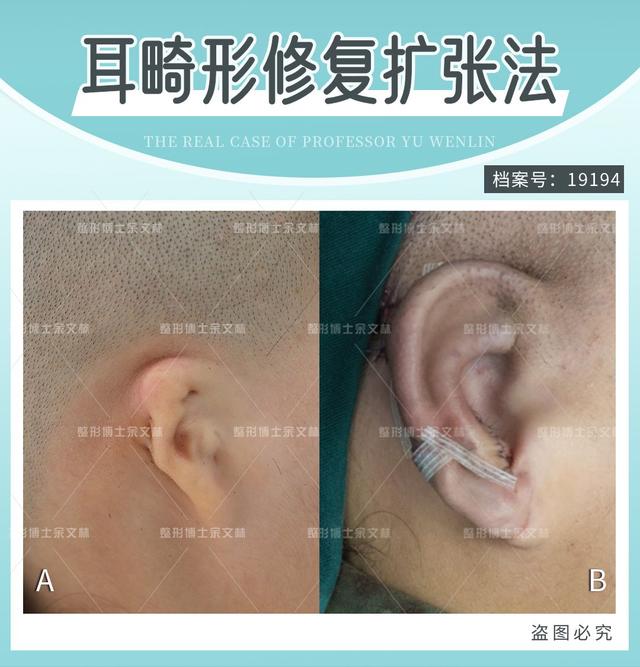 胎儿小耳畸形可以引产吗（做B超发现胎儿小耳畸形怎么办）(2)