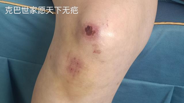 克巴世家好用吗（腿上的新伤疤是怎么来的）(2)