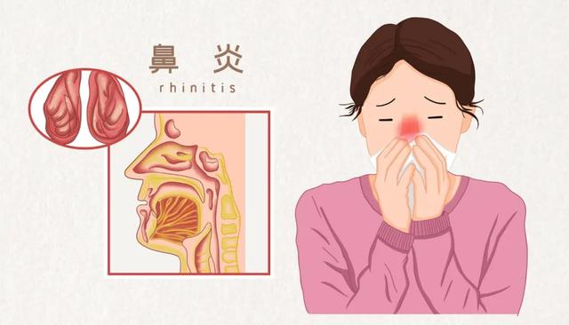 鼻炎突然发作怎么缓解（这些办法赶紧试试）(1)