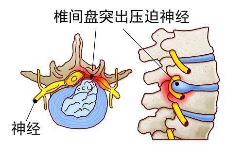 肩颈酸痛的厉害是什么原因（颈肩酸痛可能是这5种疾病造成的）