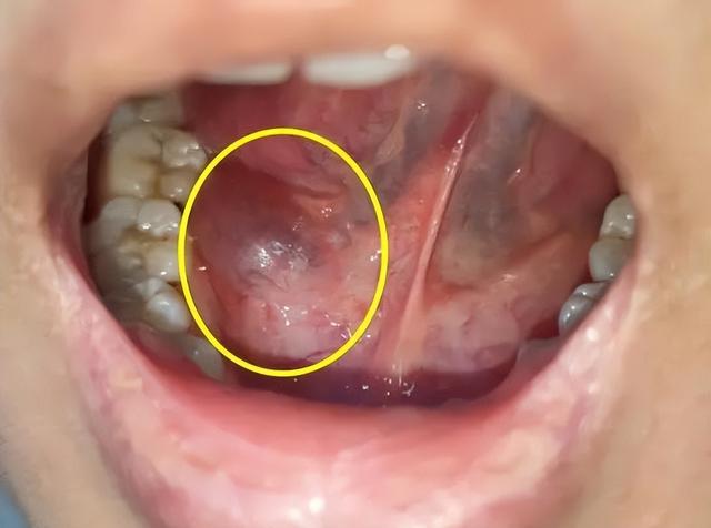 舌下腺囊肿早期怎么治疗（您知道什么是舌下腺囊肿吗）(4)
