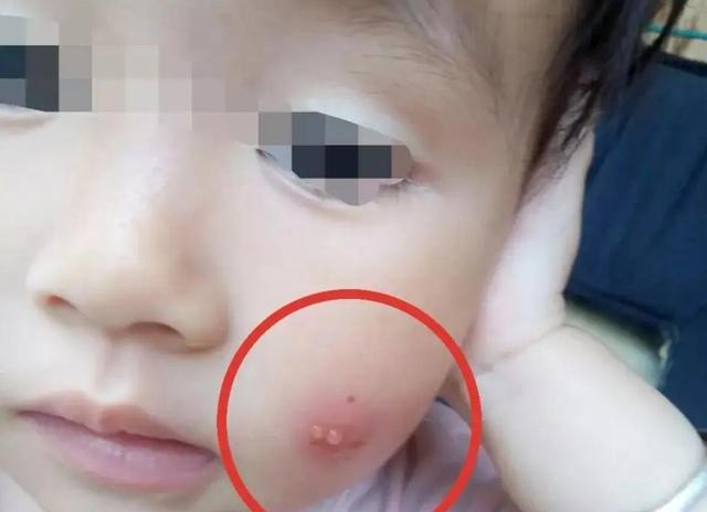 小孩被蚊子咬过敏怎么办（娃娃被蚊子咬得皮肤过敏）(1)