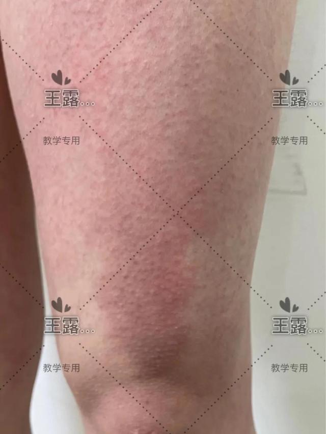 孕8个月臀部和大腿长红斑痒（少见的妊娠皮肤病）(5)