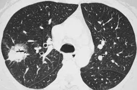 肺不好的四种症状是什么（会出现什么症状）(3)