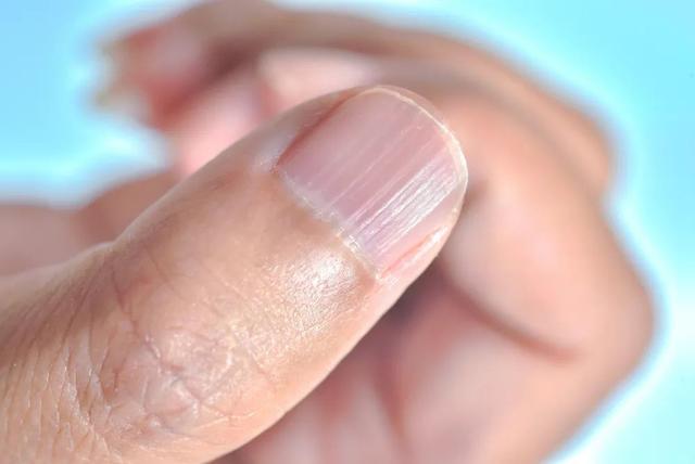 指甲有竖纹是指什么原因（指甲长竖纹说明身体不好）(2)