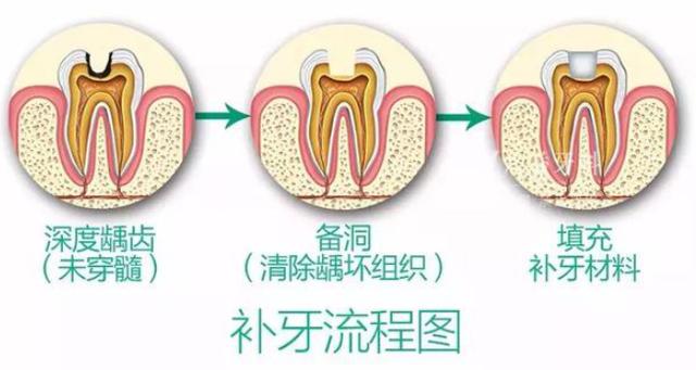 牙齿缺损的补牙过程是怎样的（牙齿缺损后需要补牙）(7)