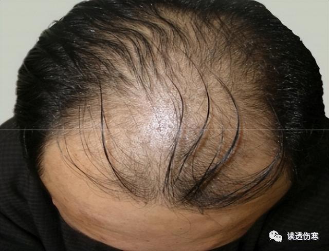 女性脂溢性脱发如何能止住脱发（治疗脂溢性脱发的妙方）(1)